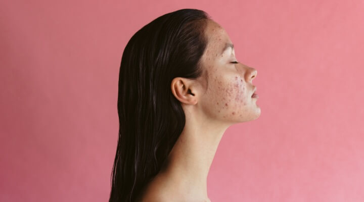 side profile of woman with acne