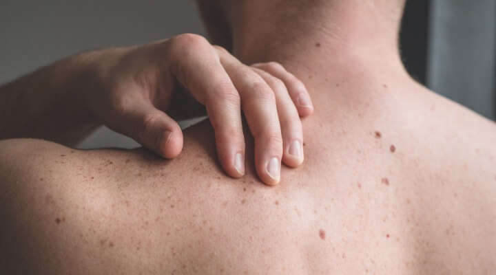 man touching back with moles