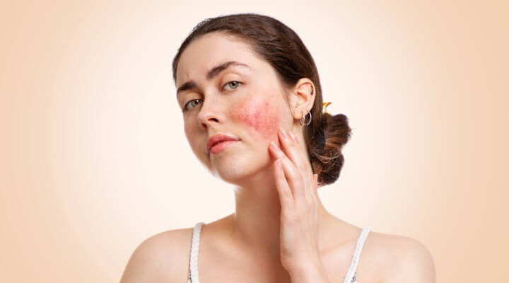 woman with rosacea touching face