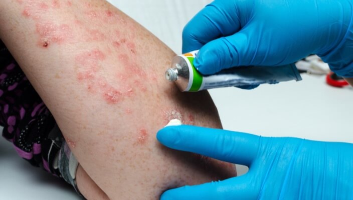 putting cream on poison ivy)