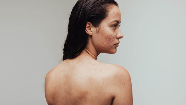 understanding adult acne
