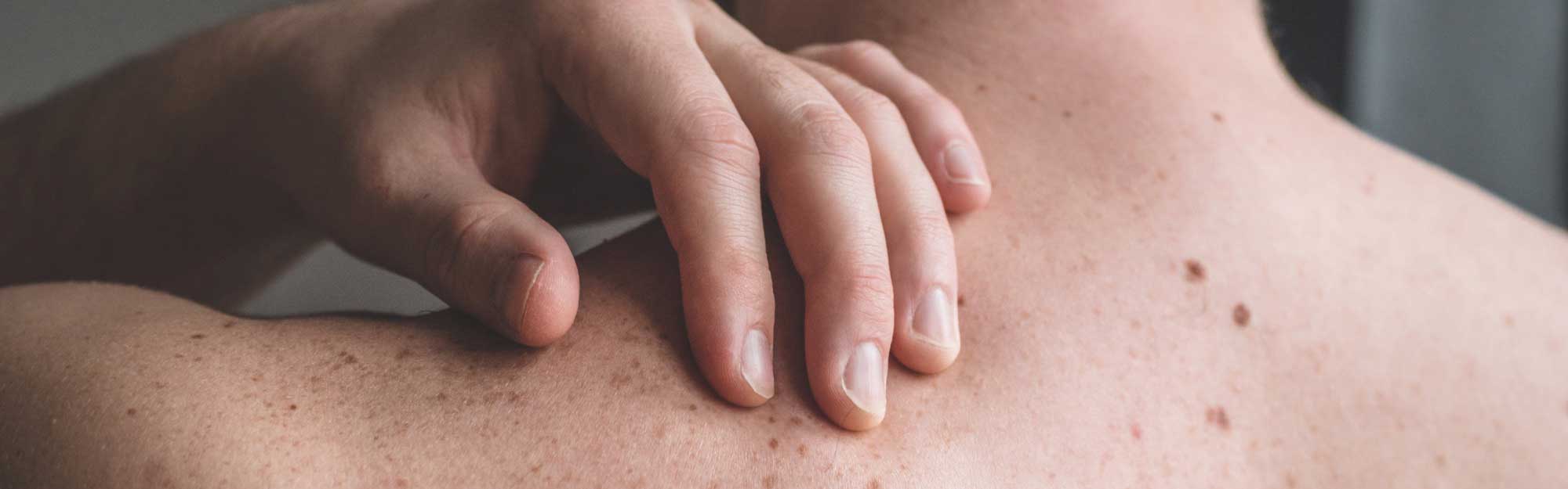 Skin Surgery Center Blog Hero - Do You Know the ABCDEs of Melanoma?