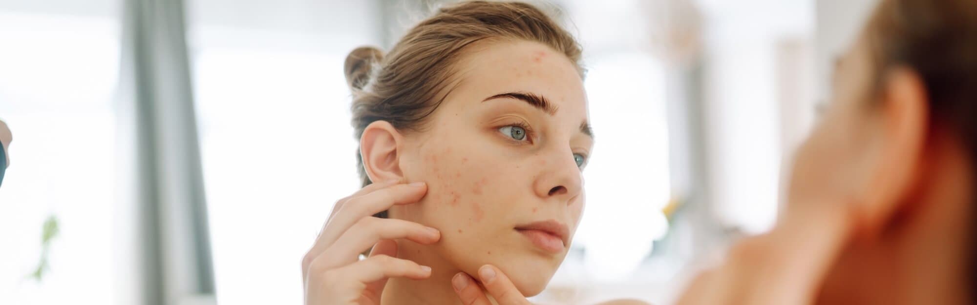 Skin Surgery Center Blog Hero - How to Handle Acne Flare-Ups