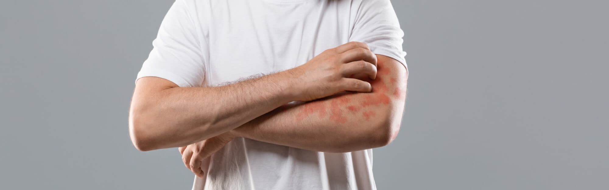 Skin Surgery Center Blog Hero - Poison Ivy Rash or Something Else?